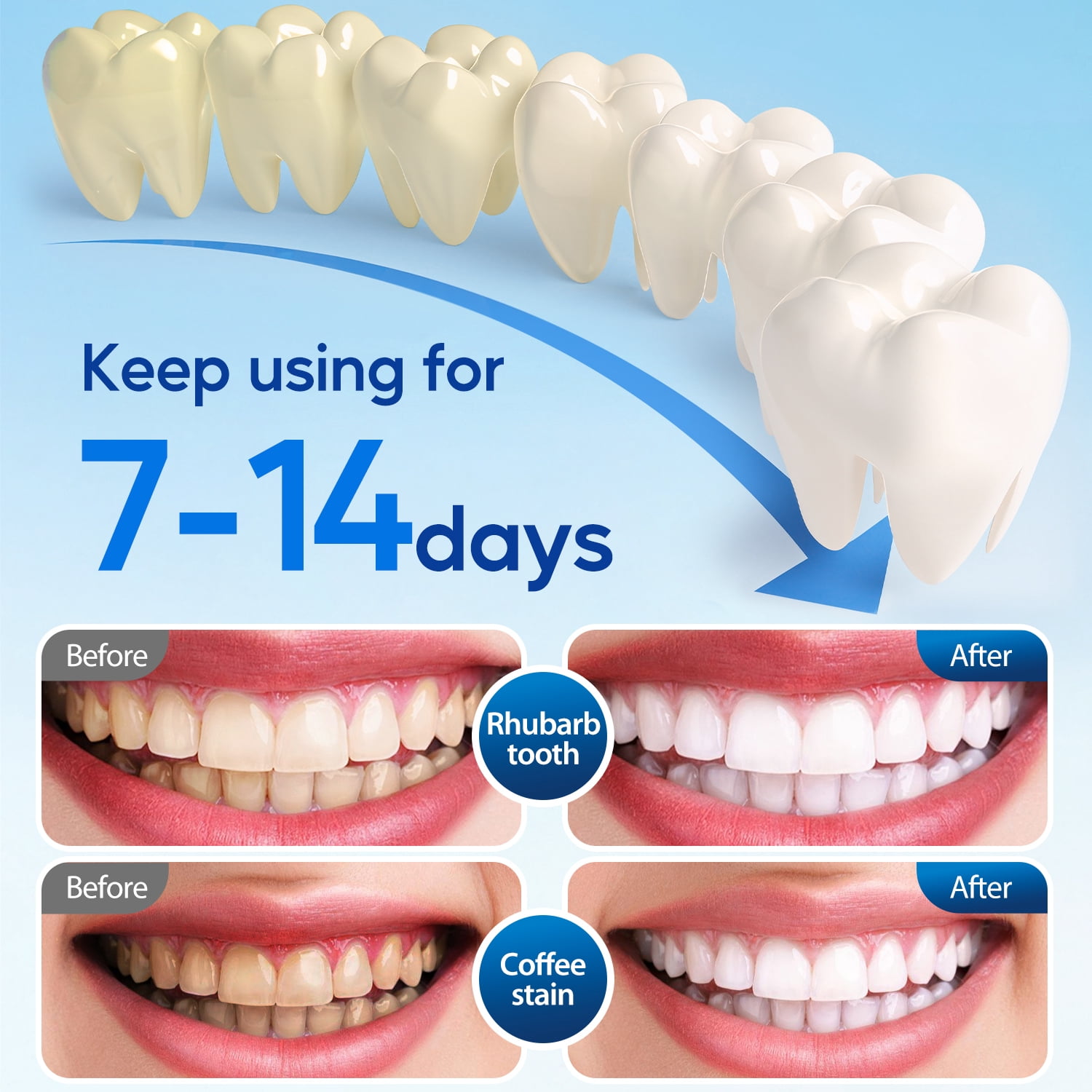 Fairywill LED Teeth Whitening Strips Kit with Blue Light Accelerator (White, 28 Strips) 95cho